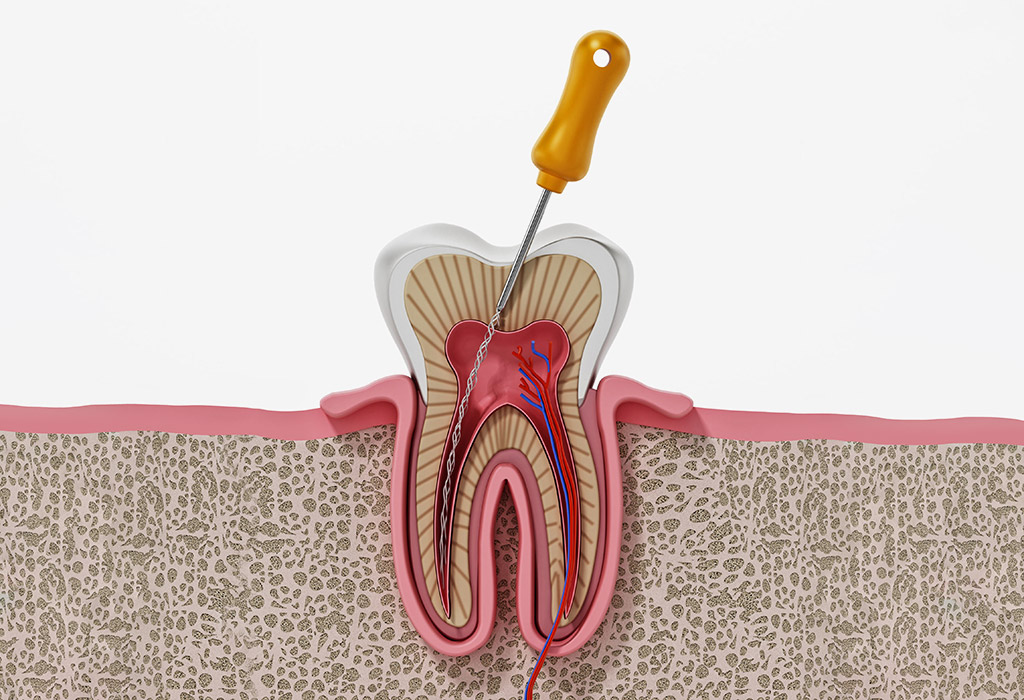 endodoncia o tratamiento de conductos